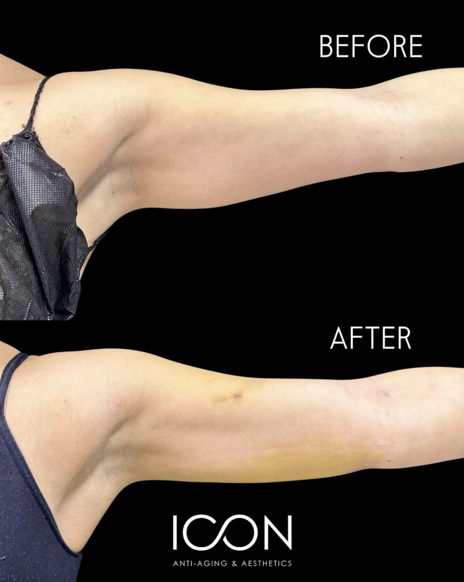 Arm Liposuction with Skin Tightening